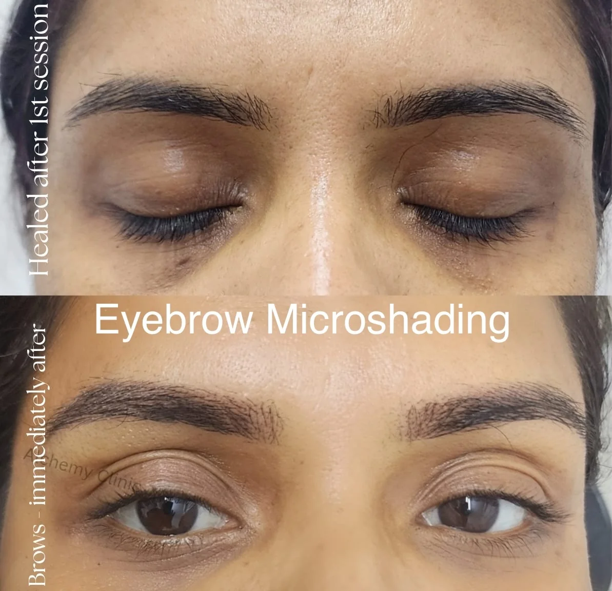 Eyebrow Microshading Alchemy Clinic Singasandra at Alchemy Clinic — Microblading, Bangalore