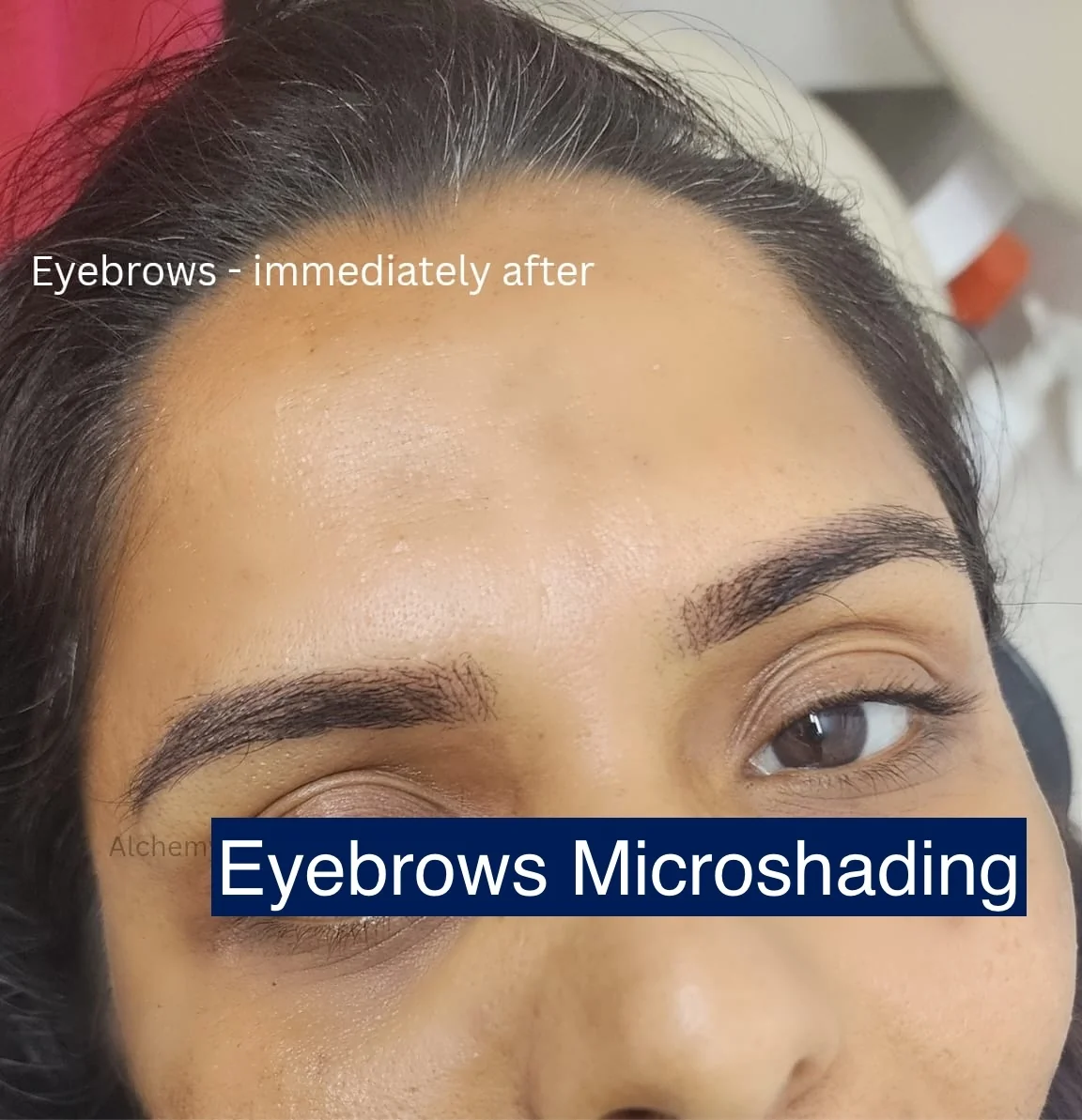 Eyebrows Microshading Treatment Alchemy Clinic Bangalore Bengaluru at Alchemy Clinic — Microblading, Bangalore