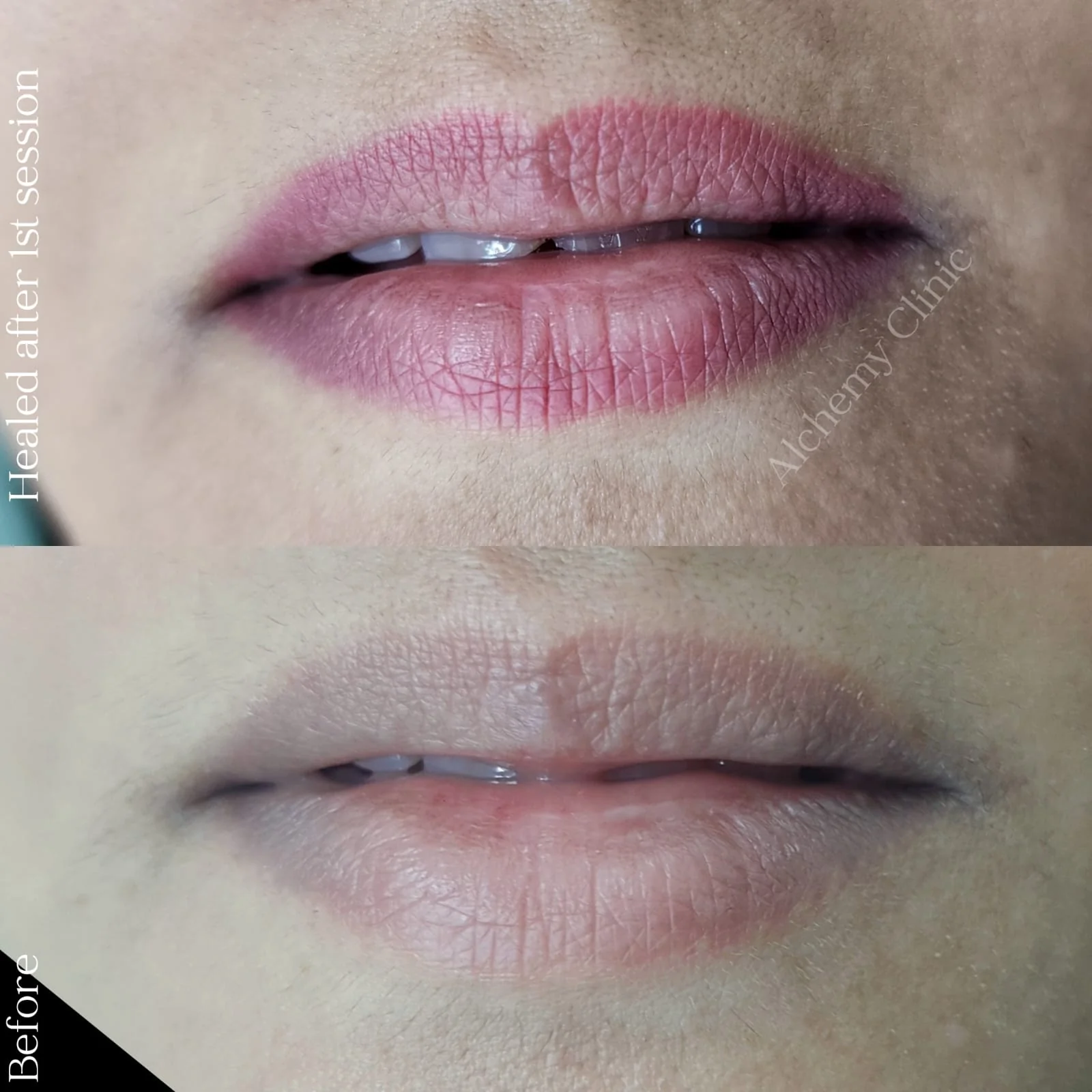 Lip blush PMU at Alchemy Clinic, Bangalore