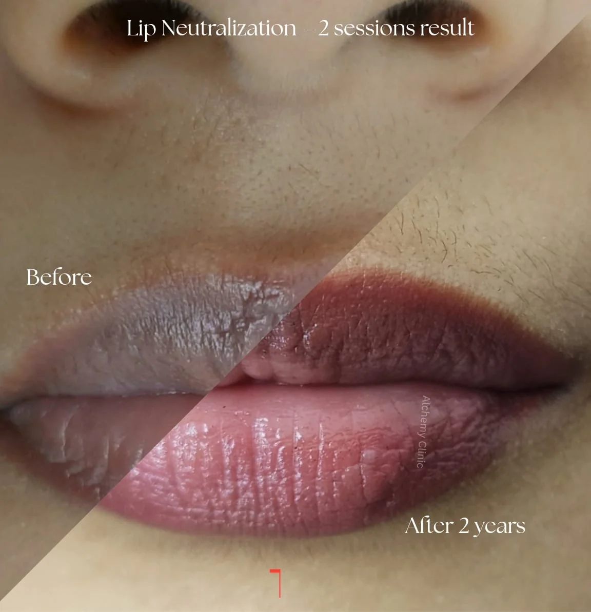 Lip neutralization PMU results at Alchemy Clinic
