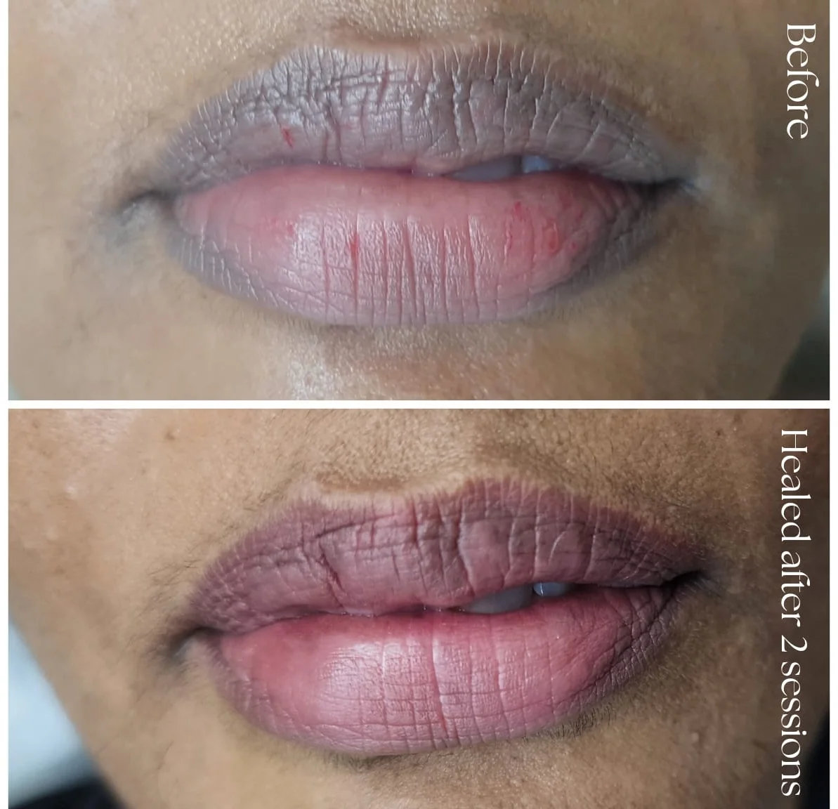 Lip neutralization treatment at Alchemy Clinic, Bangalore