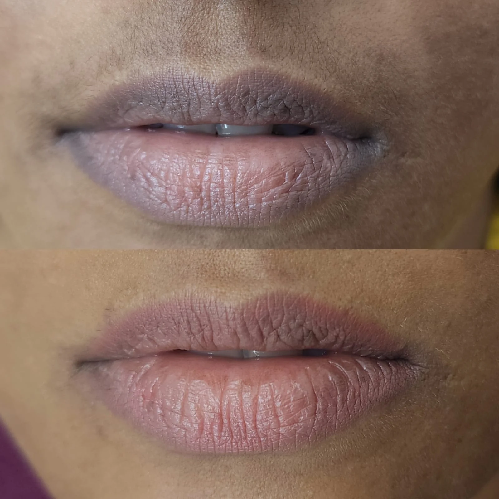 Lip transformation at Alchemy Clinic, Bangalore